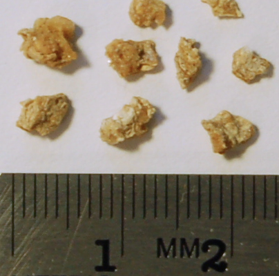 Dissolving Your Kidney Stones: The Deep Implications Are Deeper Than ...