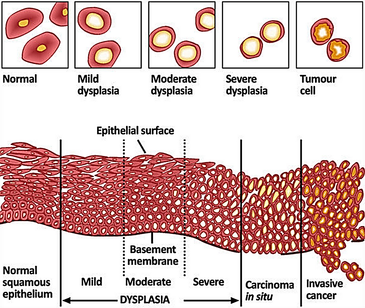 Изменение клеток матки. Стадии дисплазии шейки матки Cin. Классификация дисплазии эпителия шейки матки. Дискариоз клеток плоского эпителия шейки. Дисплазия шейки матки Cin 1-2.